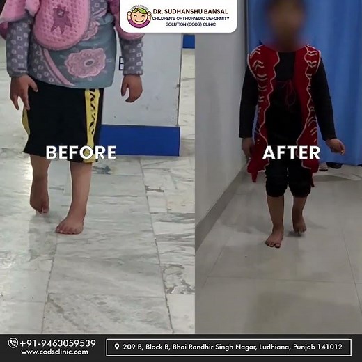 A 6 Year child Girl gets the successful Clubfoot Deformity Surgery | Cods Clinic