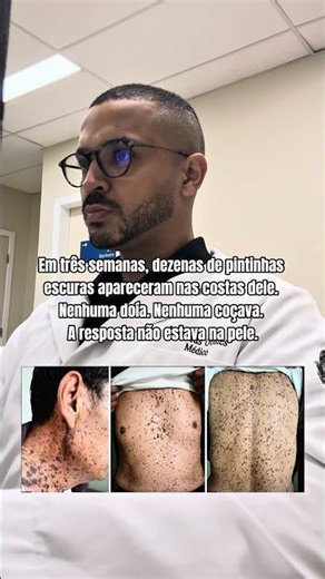 Várias verrugas surgindo de repente? Entenda o sinal de Leser-Trélat