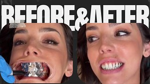 Sparkling Teeth: Top Methods for Removing Buildup