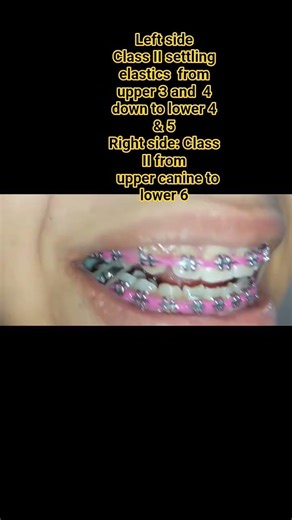 Left side:Class II settling elastics from upper 3 & 4 down to lower 4 & 5 .On Right side: Class II