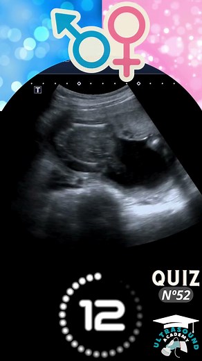Ultrasound Quiz-52: Can You Guess? Boy or Girl? | Quiz-52 | #ultrasound #babygenderprediction