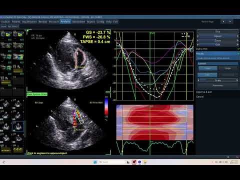 IQ 678 LRV GLS TAPSE ECHOCARDIOGRAPHY ECHOPAC ANALYSIS