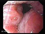 Enlarged Tonsils (2 of 2) • Video • MEDtube.net