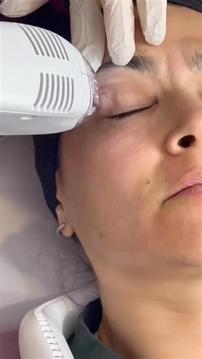 Upkeep Skin Clinic | HydraFacial | Microneedling | RF | Tixel | Tixel® Treatment for Dry Eyes Are you struggling with dry eyes? This common issue can result from an imbalance in tear composition or... | Instagram