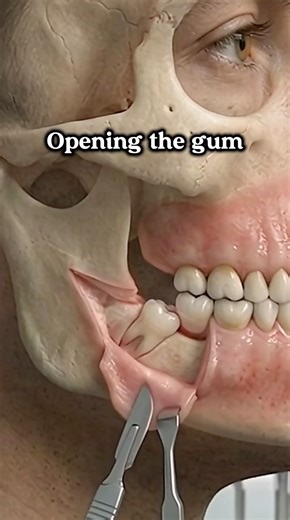 Why Your Teeth Get Crooked! 😱 (Wisdom Tooth)