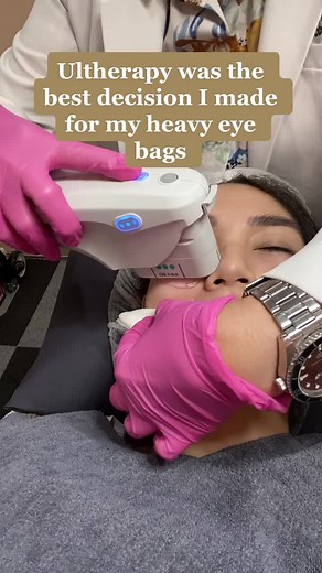 This is your sign to get ultherapy! Full effect will come after 2-3 months 😊 #ultherapy #darkcircles #eyebags #fyp