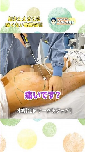 Liposuction while awake⁉️The power of epidural anesthesia!