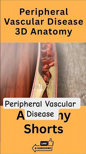Peripheral Vascular Disease in 3D 🚶‍♂️ | How Blocked Arteries Affect Blood Flow