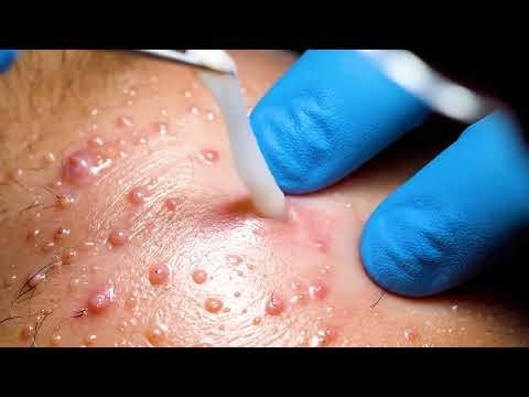 Epic Cyst Pops You Can’t Look Away From | Dr. Pimple Popper | TLC #satisfying #asmr H8794167