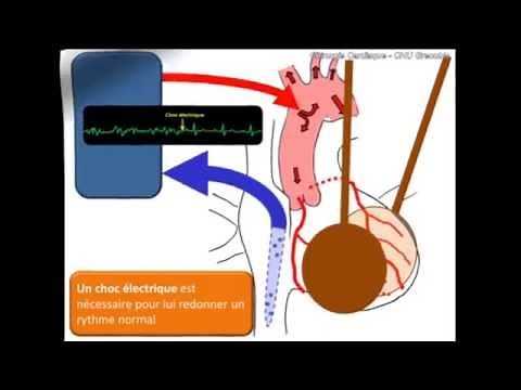 Principe de la circulation extra-corporelle ( CEC )