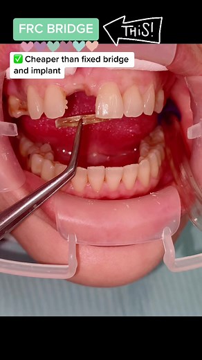 Innovative FRC Bridge at Dr. Juliana Dental Clinic