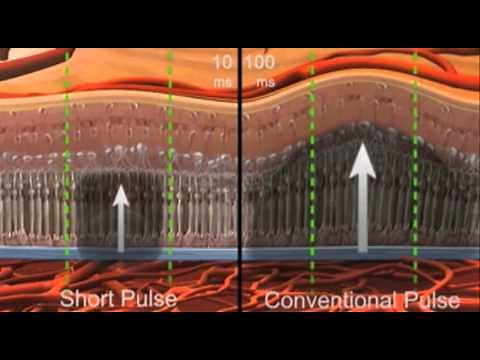PASCAL - Pattern Scanning Laser introduction