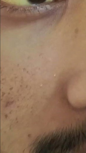 "Shades of Jaundice: The Visual Impact of Yellow Eyes"