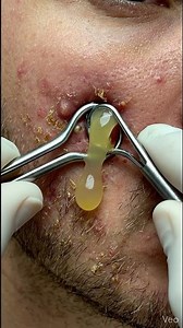 EXTREME Cystic Acne Close-Up 😳