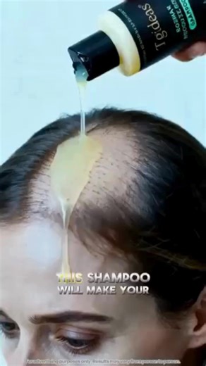 🌿 Μια νέα εποχή ενάντια στην τριχόπτωση. Η Kherastine είναι ο επαγγελματικός ορός μαλλιών που δρα απευθείας στη ρίζα, μειώνει την πτώση, ενισχύει την πυκνότητα και επαναφέρει τη δύναμη και τη ζωτικότητα στα μαλλιά — χωρίς ερεθισμούς, χωρίς επιθετικές θεραπείες. 💧 Από τις πρώτες κιόλας εφαρμογές, η συμπυκνωμένη σύνθεση θρέφει σε βάθος το τριχωτό της κεφαλής, διεγείρει τη μικροκυκλοφορία και ενδυναμώνει τον θύλακα της τρίχας, εκεί όπου γεννιέται το μαλλί. 🚫 Χωρίς δαπανηρές λύσεις. 🚫 Χωρίς περί