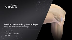 Medial Collateral Ligament Repair Using the InternalBrace™ Technique