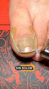 La solución más fácil para uñas encarnadas | Miss Recetas