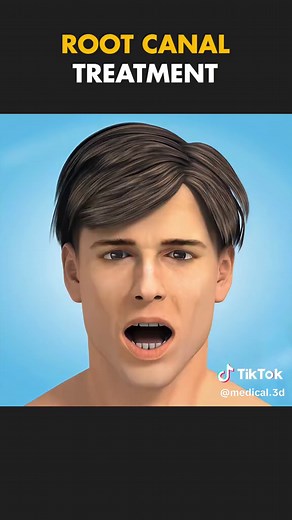 Medical World 3D (@medical.3d) - Understanding Root Canal Treatment Process