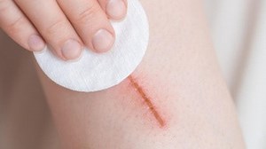 12 Penyebab Luka Tidak Kering yang Perlu Diwaspadai, Ada Riwayat Penyakit Kronis