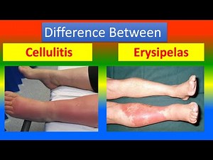 Difference between Erysipelas and Cellulitis