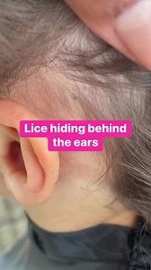 12M views · 10K reactions | A hotspot for lice is behind the ears #explore #momlife #lice #hair #Piojos | Stacey The Louse Lady | Facebook