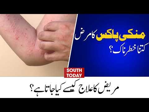 How Dangerous is Monkeypox? Symptoms, Treatment & Prevention Explained | South Today