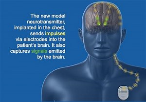 Brain stimulator makes West Coast debut in Seattle - UW Medicine - Newsroom
