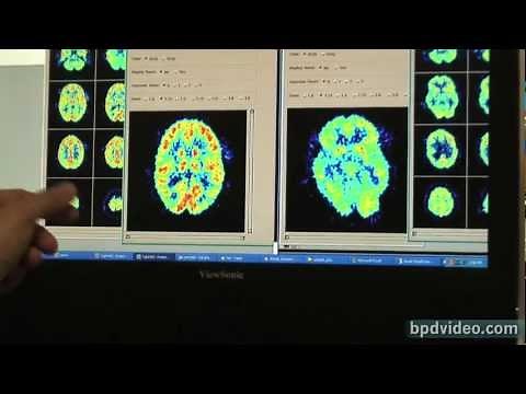 Borderline Personality Disorder