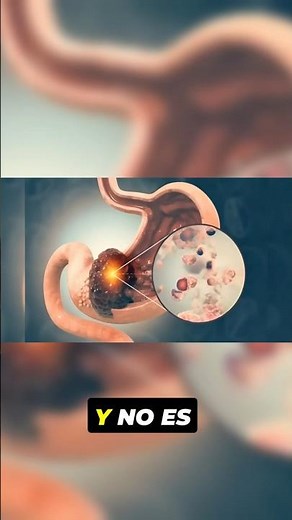 CÁNCER GASTRICO, PYLORI Y USO DE OMEPRAZOL