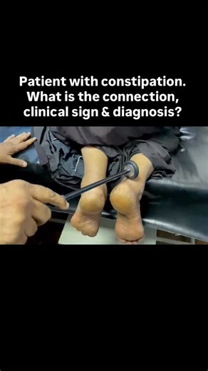 Paul Wischmeyer on Instagram: "Patient with constipation. What is the connection, clinical sign & diagnosis?"