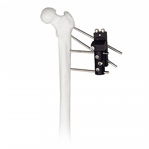 [Hot Item] High-Quality Custom Lower Limb Orthopedic Fixation Stainless Steel Distal Radius External Fixator