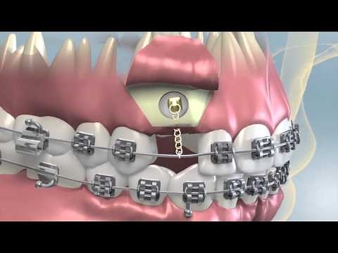 Impacted Tooth Exposure & Uncovering For Orthodontics