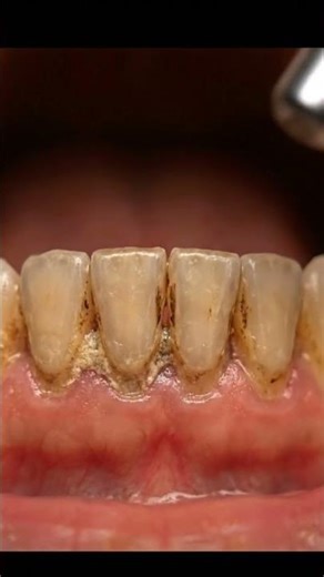 Before & After Teeth Scaling | See How Dentists Clean Teeth