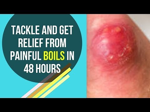 Tackle and Get Relief from Painful Boils in 48 hours