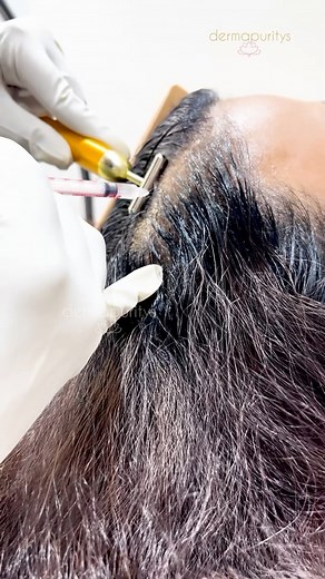 Hair mesotherapy with QR678 is a revolutionary treatment for hair rejuvenation. This non-invasive procedure involves the injection of a specially formulated QR678 solution into the scalp, stimulating hair follicles and promoting hair growth. QR678 mesotherapy has gained popularity for its effectiveness in reducing hair loss, increasing hair thickness, and restoring natural hair vitality. To book an appointment, Call Now 📍E-16, GK-1, Delhi 9958250537 📍DLF Ph-1, Gurugram 9971185019 📍Linking Roa