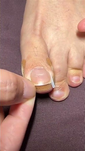 How to easily relieve foot discomfort and get perfectly aligned toes 1️⃣