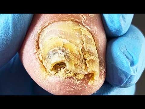 Thick onychomycosis, cut off the front of the bad nail【Podiatry Clinic】