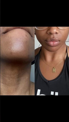 Topicals Faded Serum Before and After #skincare #hyperpigmentation #blemishes #topicalsfaded
