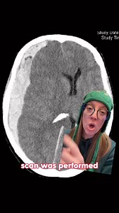 Case study 105 - The Grinch has a head injury A family in Whoville had a sudden surprise when they found the Grinch at the bottom of the chimney. What was his GCS and diagnosis? Stay tuned tomorrow and I’ll explain the whole case! #neurosurgery #casestudy #sundaycasestudy #ladyspinedoc #healthcareworker #hospital #surgery #neurosurgeon #medicalschool #medstudent #medicalstudent #nursing #pastudent #headinjury #christmas | Dr. Betsy Grunch - Ladyspinedoc
