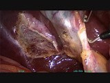 Minilaparoscopic Cholecystectomy - Half-Dome-Down Clipless Technique • Video • MEDtube.net