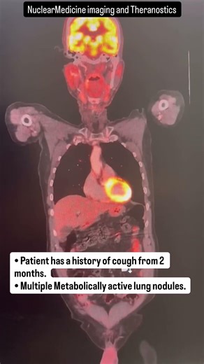 Patient with cough from 2 months || PET CT || Cancer diagnosis. #checkup #radiogyan #radiationdose