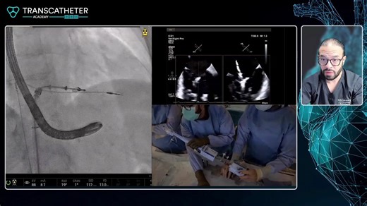 @transcatheter_academy on Instagram: "Transcatheter Tricuspid Edge-to-Edge Repair – Baylor Scott & White The Heart Hospital Plano Operator: Karim Al-Aziz Institution: Baylor Scott & White The Heart Hospital – Plano Technology: ICE-Guided Independent Grasping and Leaflet Optimization With TriClip Once adequate leaflet insertion into the device stem was confirmed, the team proceeded deliberately, working closely with the imager to fine-tune positioning. Using controlled clocking and counterclockin