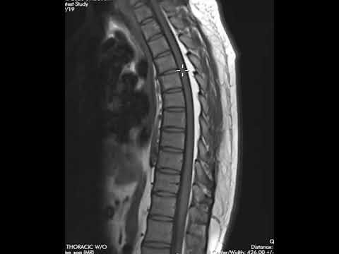 Epidural lipomatosis