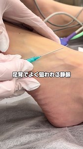 足背の静脈ルート確保の重要性