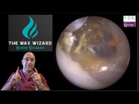 The wax wizard! - Episode 111 #earwaxremoval #earwax #earwaxclinic #earwaxextraction