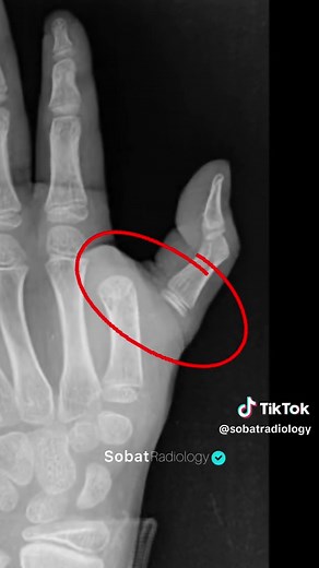 Understanding Metacarpophalangeal Joint Dislocation