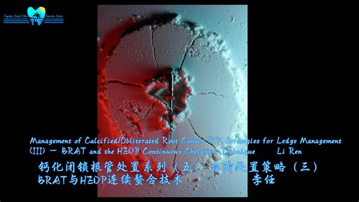 闭锁根管疏通（五）台阶处置（三）