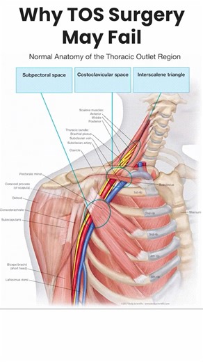 Why TOS Surgery Fails So Often