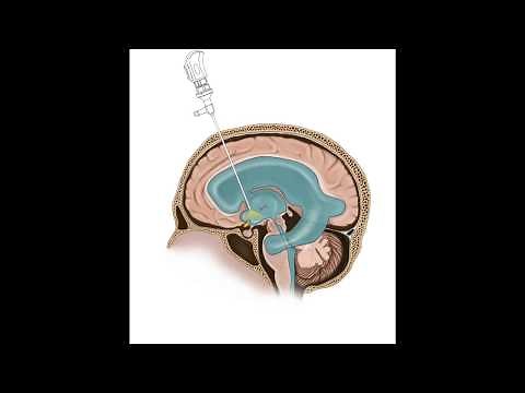 Updated Video Available: Endoscopic Third Ventriculostomy Animation