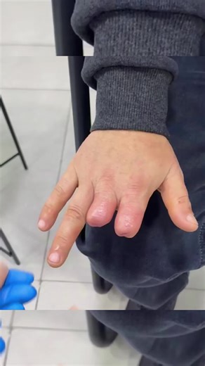 Custom Silicone Fingers: The Future of Hand Prosthetics